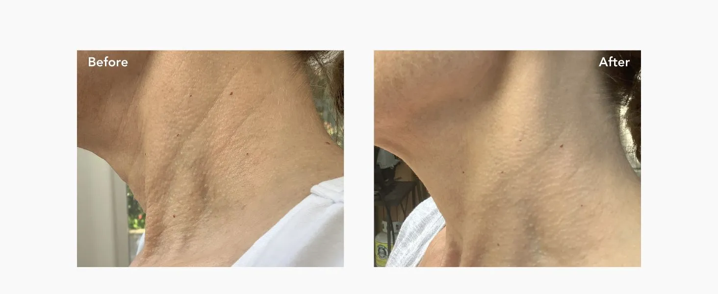 Before and after Riversol Retinol Neck Cream — 30 days of consistent use, raw customer photos