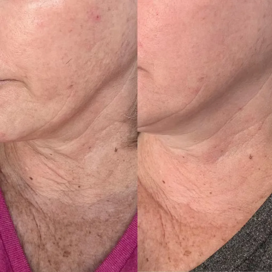 Before and after, neck — Tonya Kennedy