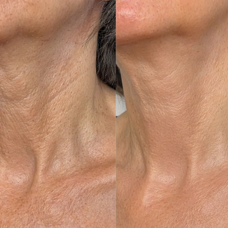 Before and after, neck — Lucy Tilgner