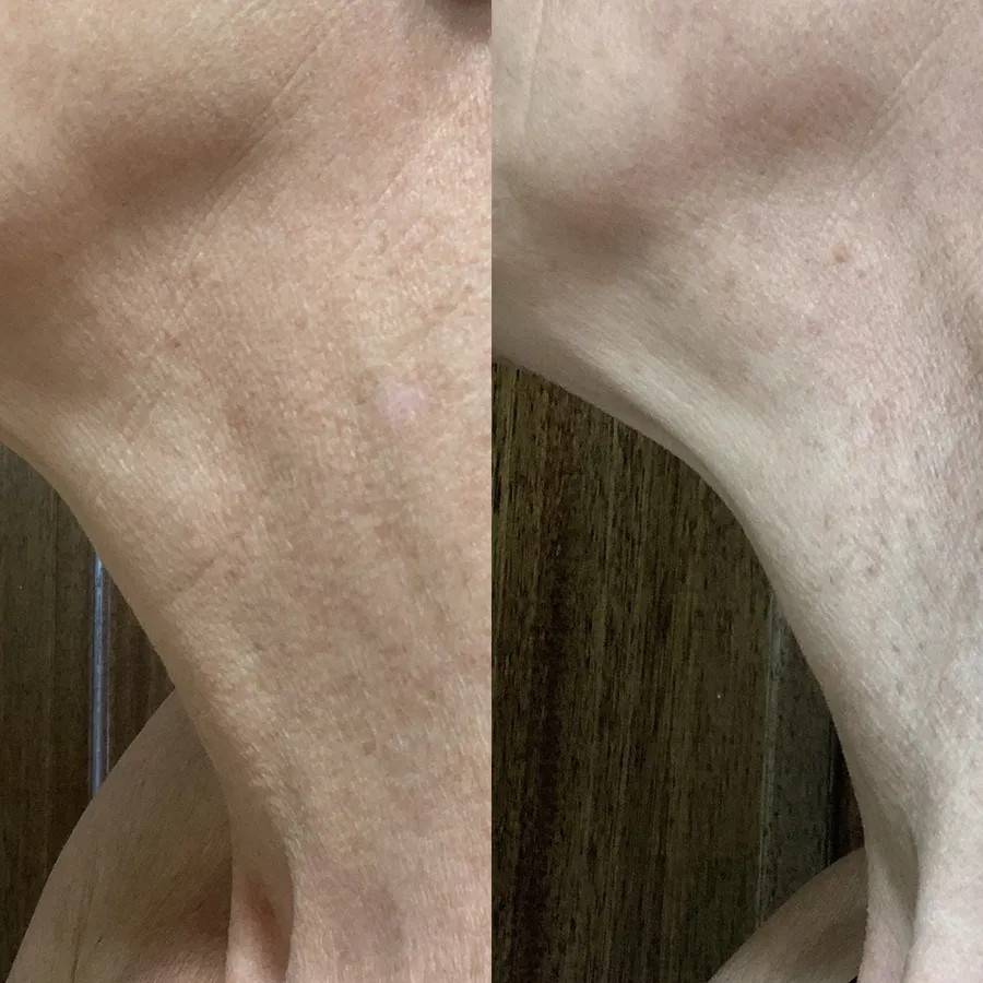 Before and after, neck — Cheryl Brignell