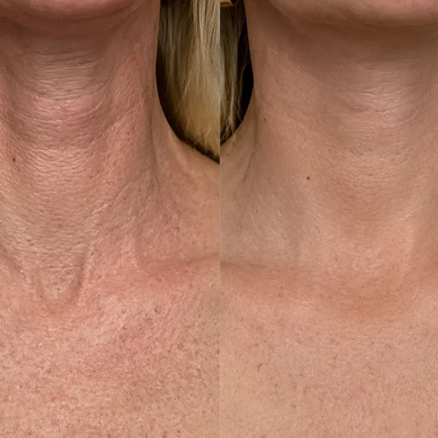 Before and after, neck — Patricia Moore