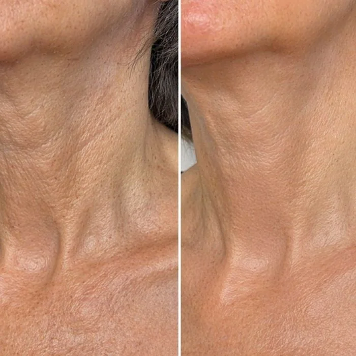 Before and after - neck skin improvement after using Riversol Retinol Neck Cream